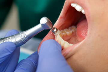 クリーニング、予防歯科